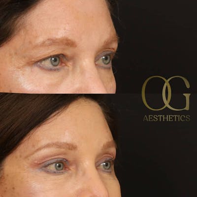 Blepharoplasty Before & After Gallery - Patient 194520665 - Image 1