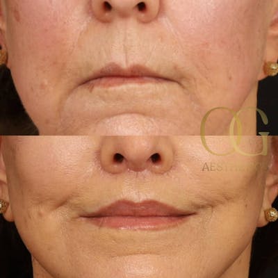 Lip Lift Before & After Gallery - Patient 194520661 - Image 1