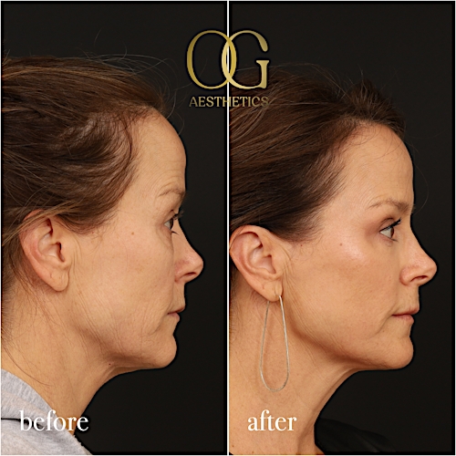 Laser Resurfacing Before & After Gallery - Patient 199550500 - Image 4