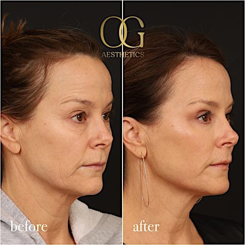 Laser Resurfacing Before & After Gallery - Patient 199550500 - Image 3