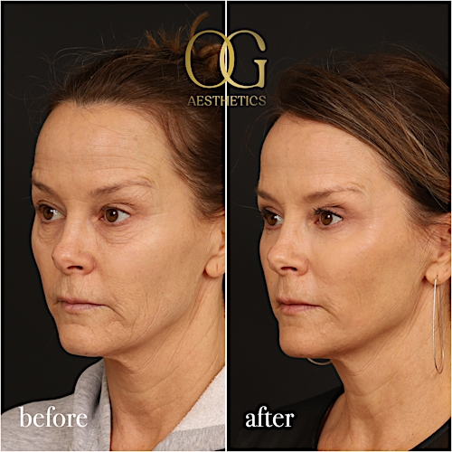 Laser Resurfacing Before & After Gallery - Patient 199550500 - Image 5