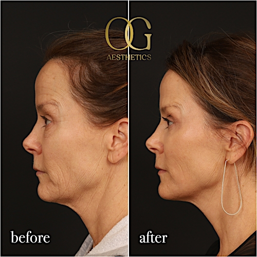 Laser Resurfacing Before & After Gallery - Patient 199550500 - Image 6