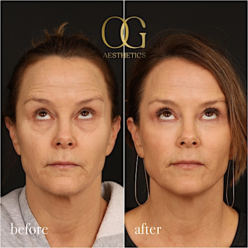 Laser Resurfacing Before & After Gallery - Patient 199550500 - Image 2