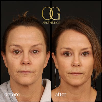 Laser Resurfacing Before & After Gallery - Patient 199550500 - Image 1