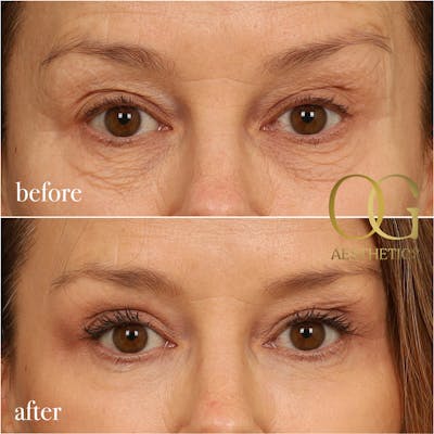 Blepharoplasty Before & After Gallery - Patient 199550499 - Image 1