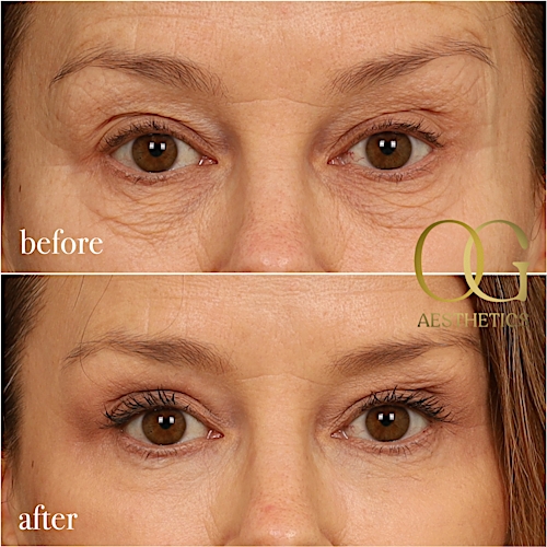 Blepharoplasty Before & After Gallery - Patient 199550499 - Image 1