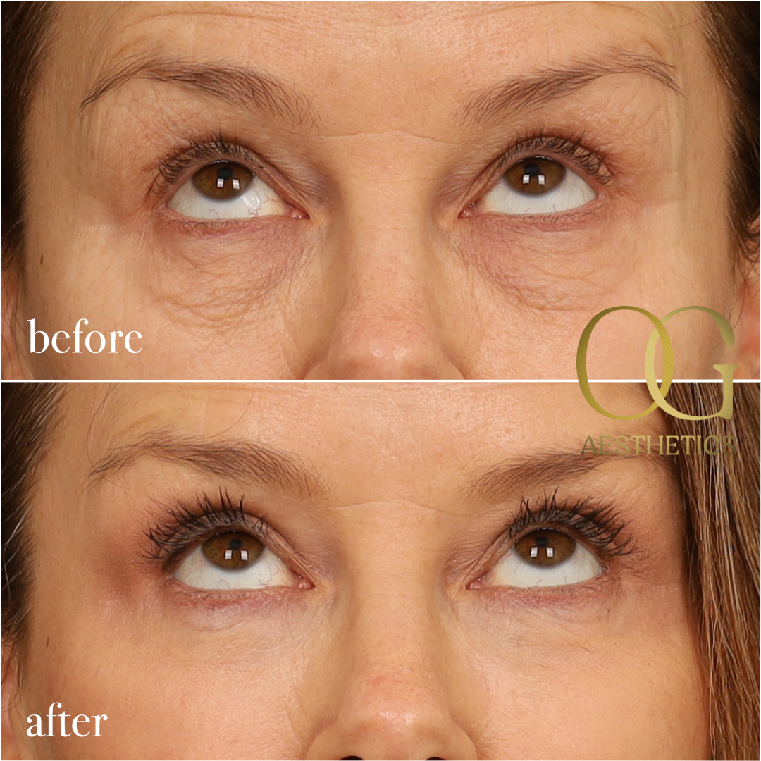 Blepharoplasty Before & After Gallery - Patient 199550499 - Image 2
