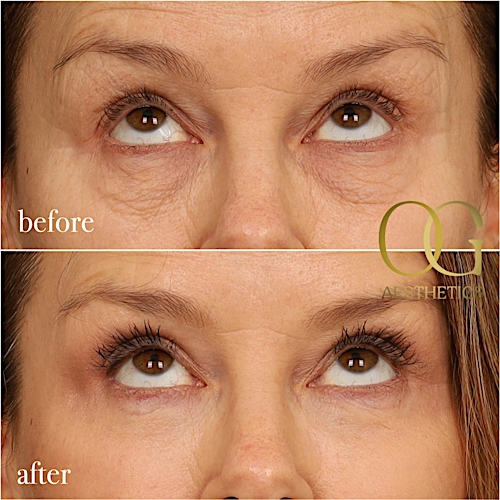 Blepharoplasty Before & After Gallery - Patient 199550499 - Image 2