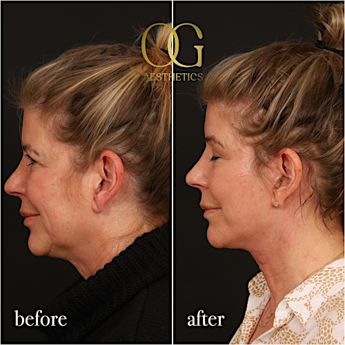 Neck Lift Before & After Gallery - Patient 278775 - Image 6