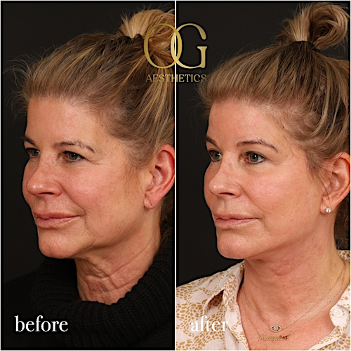 Neck Lift Before & After Gallery - Patient 278775 - Image 5