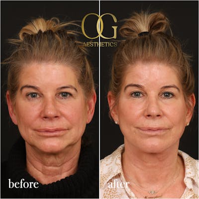 Neck Lift Before & After Gallery - Patient 278775 - Image 1