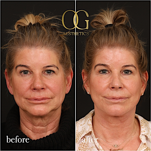 Facelift Before & After Gallery - Patient 199550503 - Image 1