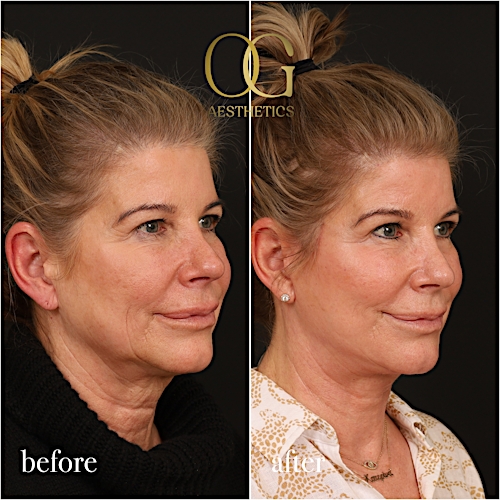 Facelift Before & After Gallery - Patient 199550503 - Image 3