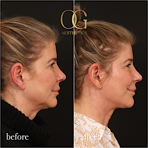 Laser Resurfacing Before & After Gallery - Patient 199550501 - Image 4