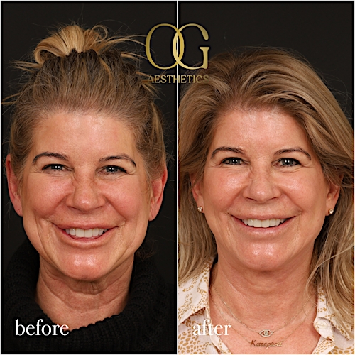 Neck Lift Before & After Gallery - Patient 278775 - Image 2