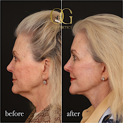 Neck Lift Before & After Gallery - Patient 120495 - Image 5