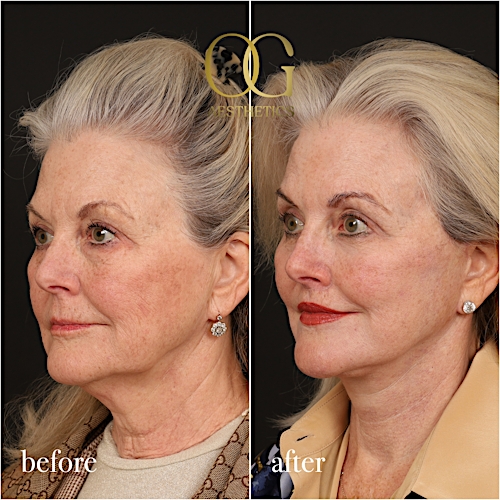 Facelift Before & After Gallery - Patient 193050 - Image 4