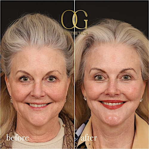 Neck Lift Before & After Gallery - Patient 120495 - Image 1