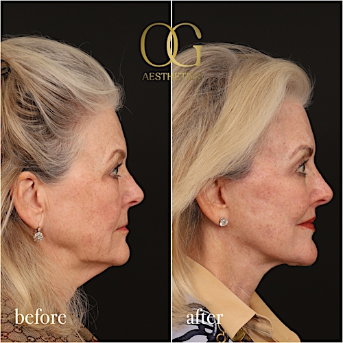 Blepharoplasty Before & After Gallery - Patient 400100 - Image 3