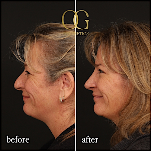 Rhinoplasty Before & After Gallery - Patient 340768 - Image 1