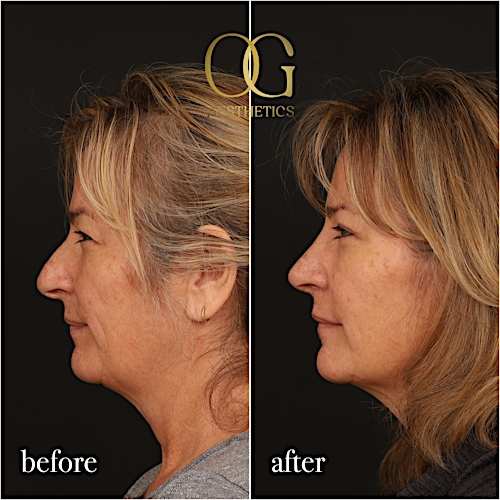 Blepharoplasty Before & After Gallery - Patient 424411 - Image 4