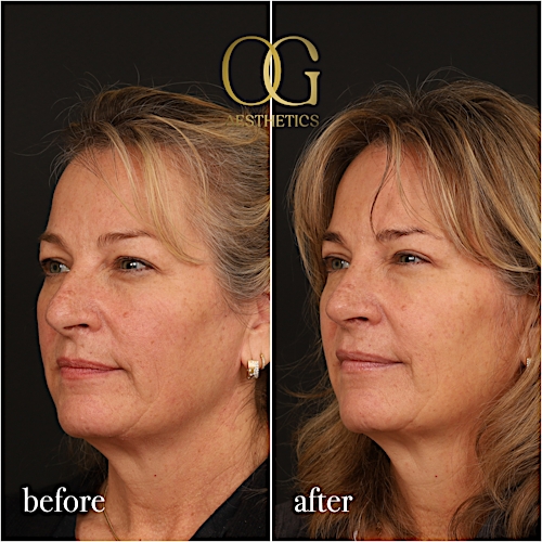 Blepharoplasty Before & After Gallery - Patient 424411 - Image 5