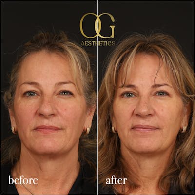 Blepharoplasty Before & After Gallery - Patient 424411 - Image 1