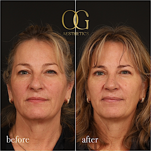 Rhinoplasty Before & After Gallery - Patient 340768 - Image 4
