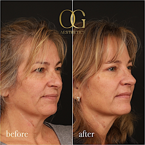Blepharoplasty Before & After Gallery - Patient 424411 - Image 2