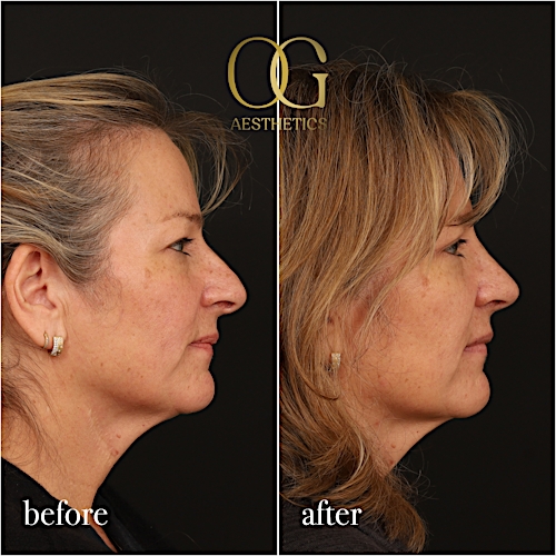 Blepharoplasty Before & After Gallery - Patient 424411 - Image 6