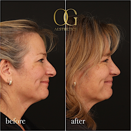 Blepharoplasty Before & After Gallery - Patient 424411 - Image 7