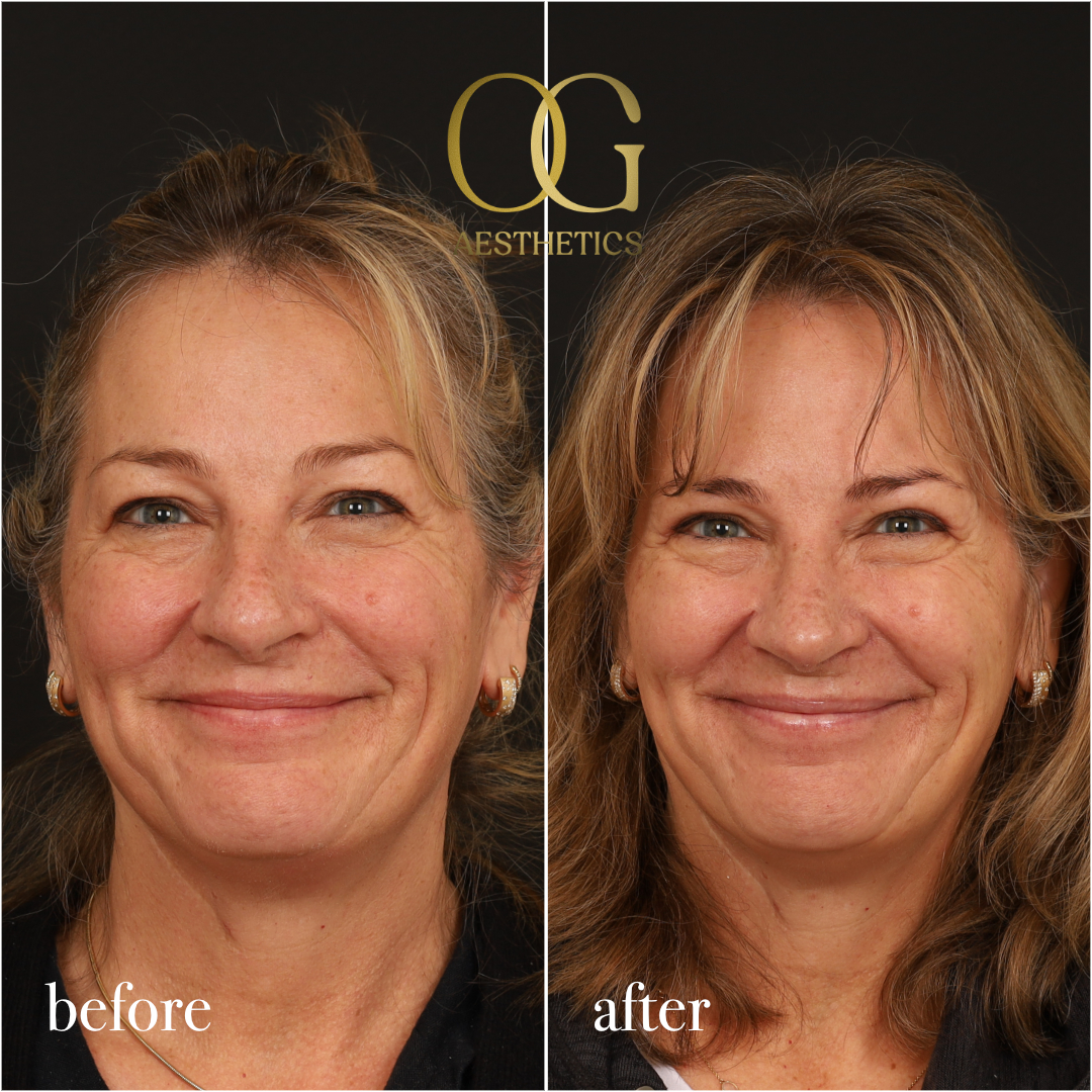 Rhinoplasty Before & After Gallery - Patient 340768 - Image 8