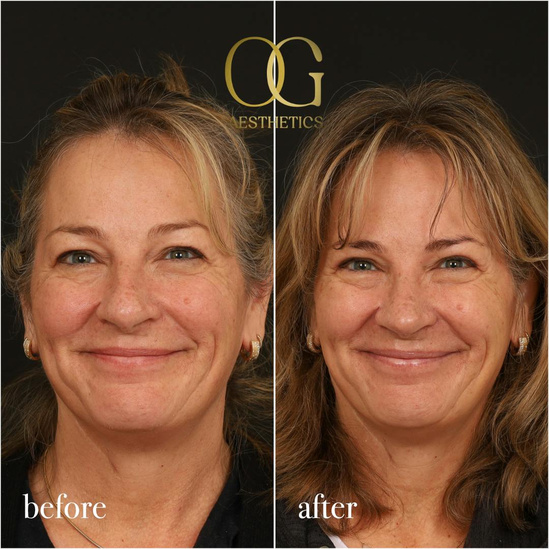 Blepharoplasty Before & After Gallery - Patient 424411 - Image 8