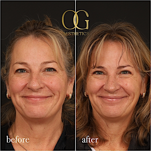 Blepharoplasty Before & After Gallery - Patient 424411 - Image 8