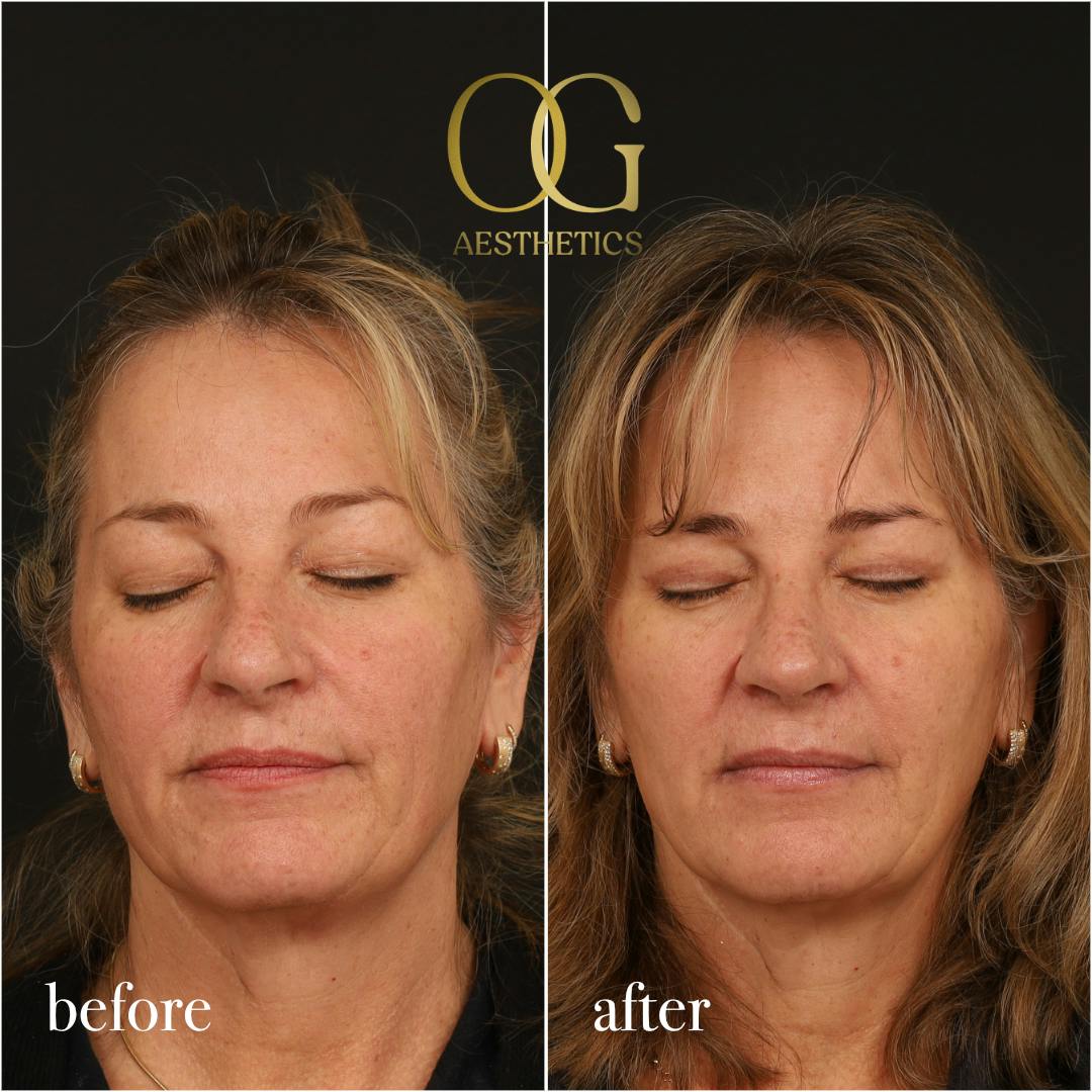 Blepharoplasty Before & After Gallery - Patient 424411 - Image 9