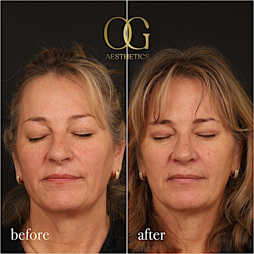 Blepharoplasty Before & After Gallery - Patient 424411 - Image 9