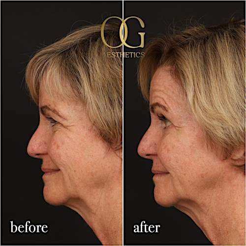 Blepharoplasty Before & After Gallery - Patient 288370 - Image 6