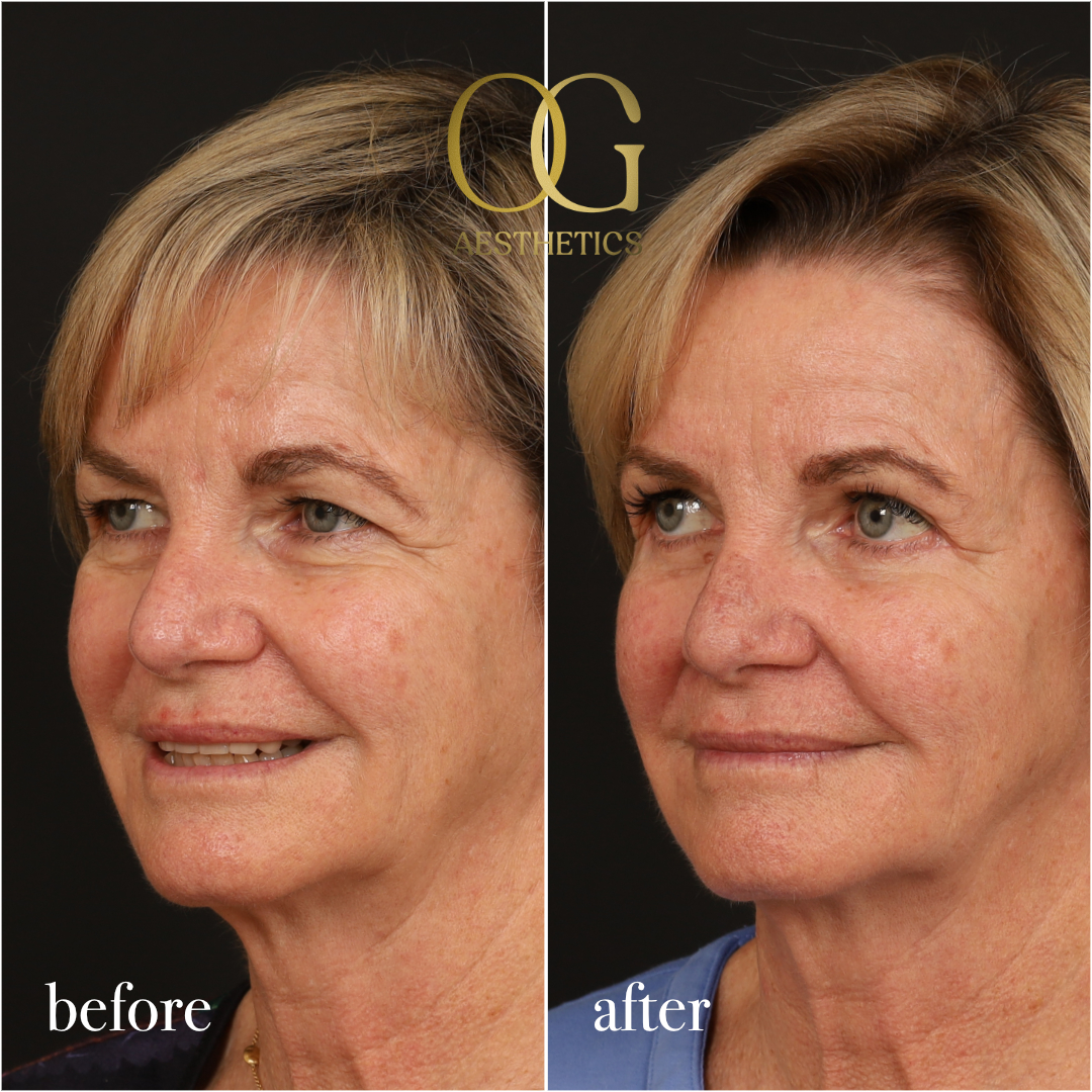 Blepharoplasty Before & After Gallery - Patient 288370 - Image 5