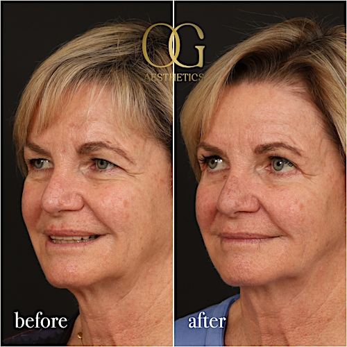 Blepharoplasty Before & After Gallery - Patient 288370 - Image 5