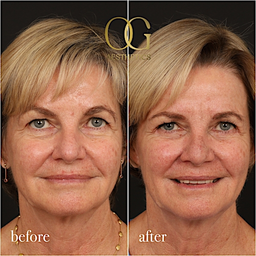 Blepharoplasty Before & After Gallery - Patient 288370 - Image 1