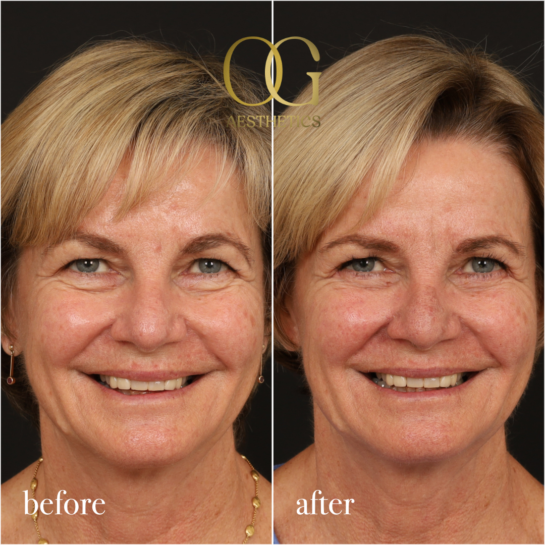 Blepharoplasty Before & After Gallery - Patient 288370 - Image 2