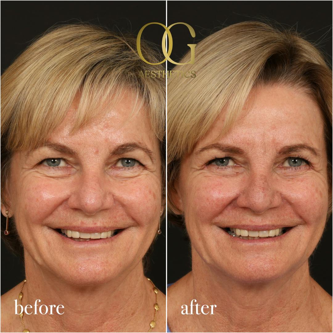 Blepharoplasty Before & After Gallery - Patient 288370 - Image 2