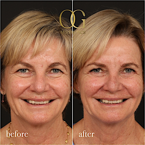 Blepharoplasty Before & After Gallery - Patient 288370 - Image 2