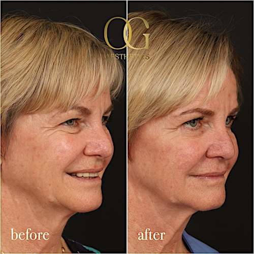 Blepharoplasty Before & After Gallery - Patient 288370 - Image 3