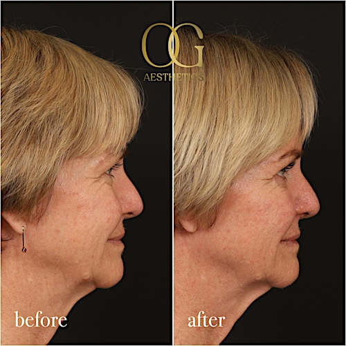 Blepharoplasty Before & After Gallery - Patient 288370 - Image 4