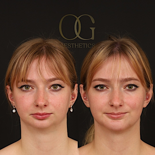 Chin Augmentation Before & After Gallery - Patient 352579 - Image 3
