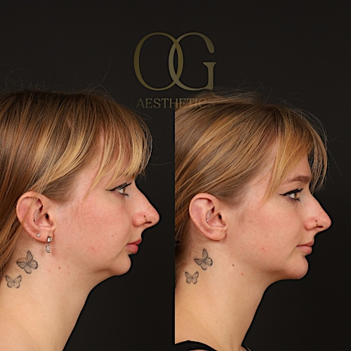 Chin Augmentation Before & After Gallery - Patient 352579 - Image 1