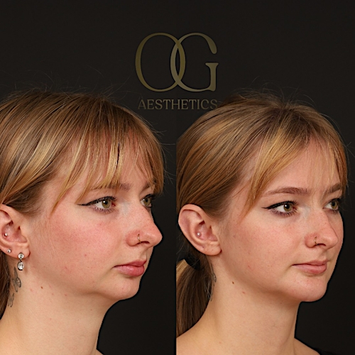 Chin Augmentation Before & After Gallery - Patient 352579 - Image 2