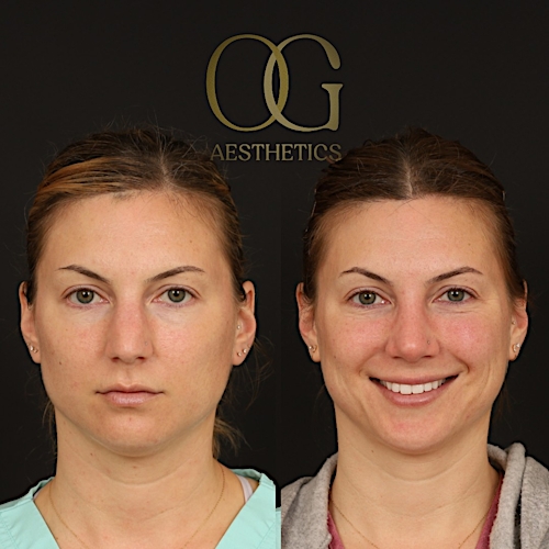 Rhinoplasty Before & After Gallery - Patient 316259 - Image 2