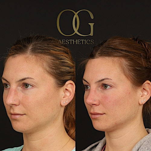 Rhinoplasty Before & After Gallery - Patient 316259 - Image 3
